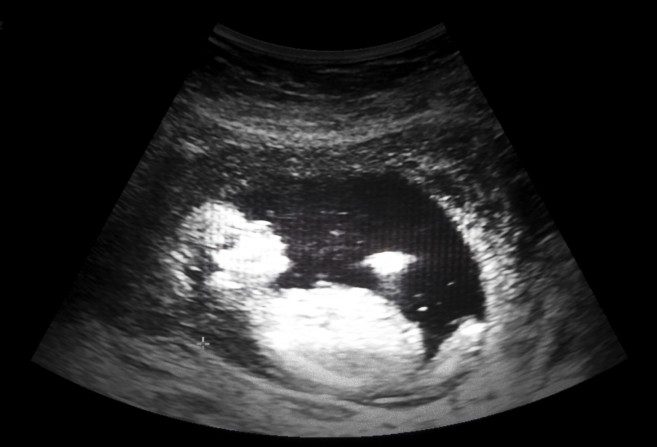 Imagen ilustrativa de un ultrasonido tridimensional de un bebé en el vientre de su madre. (Valentin Arr/iStock)
