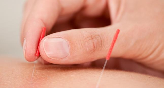 Descubren las sensaciones del qi en la acupuntura. (Shutterstock*)