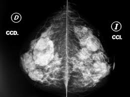 Nodulos BR3 en una Mamografía. Científicos desarrollan un guante con nanosensores para detectar el cáncer. (commons.wikimedia.org)
