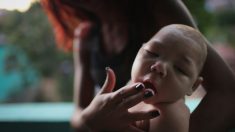 Zika puede provocar muerte fetal, hidropesía e hidranencefalia