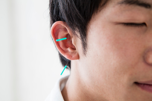 Tratamiento de acupuntura. Foto: kokouu / Getty Images