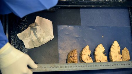 La cura del Alzheimer, ¿cada vez más cerca?