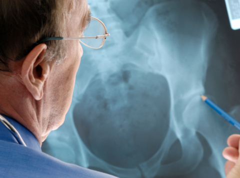 Doctor examinando osteoporosis sobre radiografía con rayos - x. (Foto: Chris Fertnig)