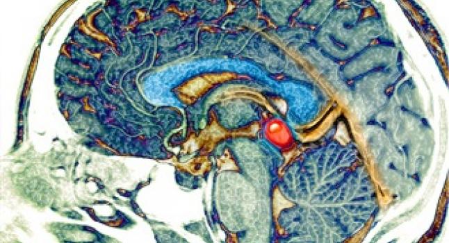 Glándula pineal en el cerebro humano. (Living Art Enterprises/Getty Images)