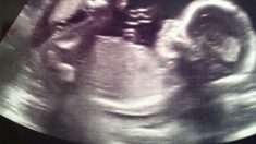 Un “ángel” apareció sobre un bebé en el ultrasonido de una mamá, la imagen es tan nítida que emociona