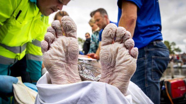 Nada 163 km recaudando fondos contra el cáncer: así quedaron sus manos y pies por su heroico esfuerzo