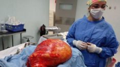 Extirpan gigantesco tumor de 17 kilos y devuelven la alegría a una paciente de México
