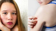 9 señales en tu piel que hablan de tu salud: la comezón puede ser un signo de enfermedad hepática