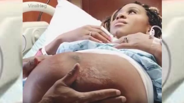 Doctor milagrosamente reposiciona al bebé dentro del vientre para evitar una peligrosa cirugía