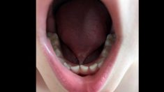 Niño no hablaba hasta que un dentista descubre que tiene la “lengua atada”