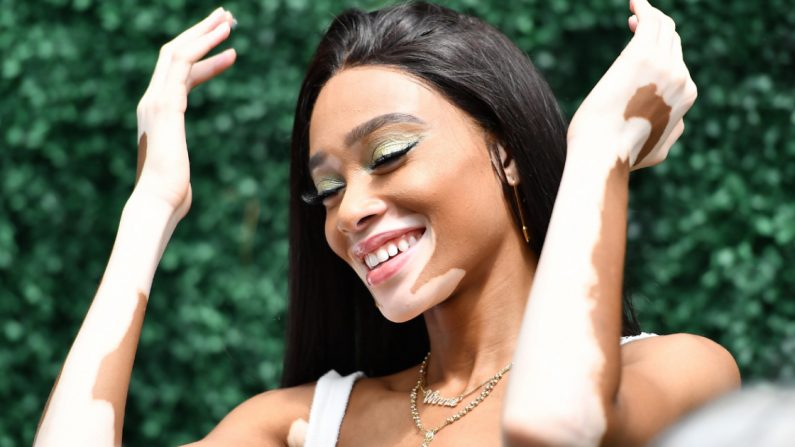 Winnie Harlow. (Crédito: ANGELA WEISS/AFP/Getty Images)