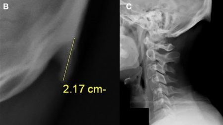 Consecuencias de mirar tanto el móvil: saca papada y hace que crezca un ‘cuerno’ en el cráneo