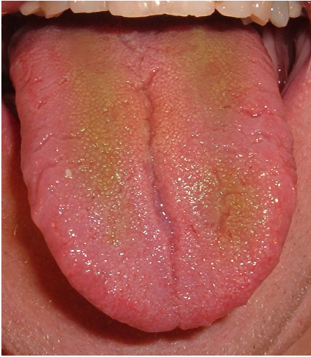 Color de la lengua