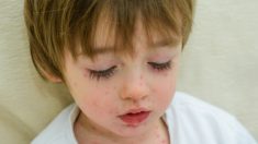 Bebé nace con manchas parecidas a la varicela que resultan ser una rara enfermedad de 1 entre 100.000