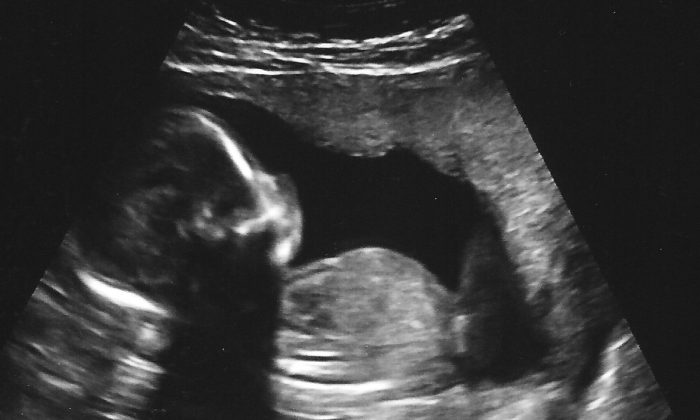 Imagem de ultra-som de um bebê na 18ª semana de gravidez ("Baby McBride Ultrasound 17 Semanas 6 Dias (3)" por Nogwater / Flickr [CC BY-SA-2.0 (ept.ms/2utDIe9)])