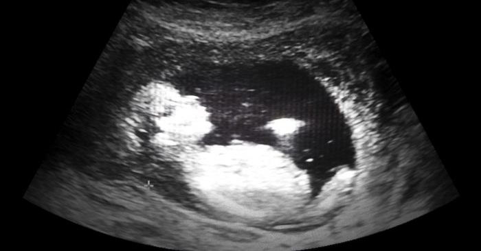 Foto de archivo de una imagen de ultrasonido de un feto. (Kornn Photo/iStock)