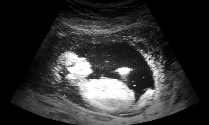 Foto de arquivo de um ultrassom de um feto (Foto Kornn / iStock)