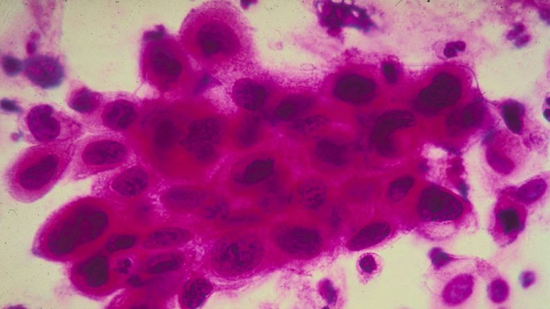 Células cancerígenas no colo do útero. Câncer do colo uterino, a porção do útero que é anexada ao topo da vagina (Foto de American Cancer Society / Getty Images)