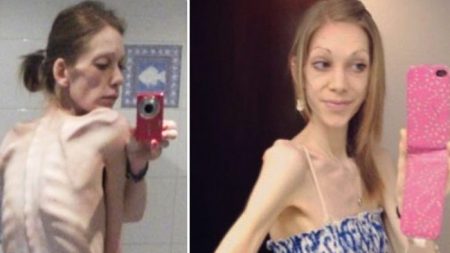 À beira da morte, adolescente anoréxica que pesava 24 kg é salva pelo fisiculturismo