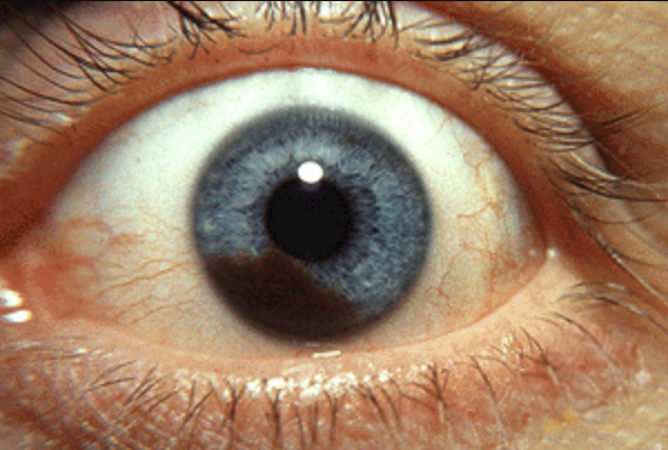 Melanoma en el iris del ojo (Wikimedia Commons)