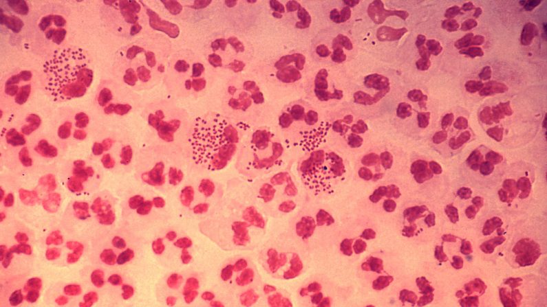 Esta microfotografía de baja resolución revela la histopatología en un caso agudo de uretritis gonocócica mediante la técnica de tinción de Gram. Esta diapositiva se utiliza para demostrar la distribución no aleatoria de los gonococos entre neutrófilos polimorfonucleares. (CDC vía Wikimedia Commons)