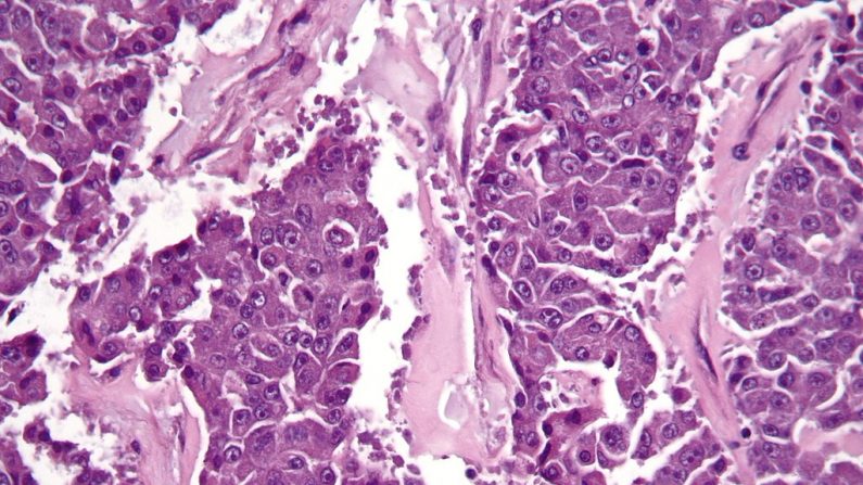 Carcinoma de Célula Acinar (Nephron/Wikimedia Commons)