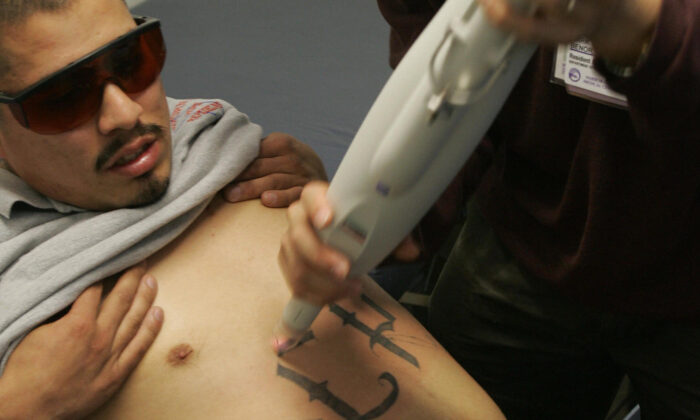 Un médico utiliza una máquina láser para comenzar la eliminación de tatuajes de un exmiembro de una pandilla en una clínica de eliminación de tatuajes en el Este de Los Ángeles, el 23 de marzo de 2005. (Robyn Beck/AFP/Getty Images)