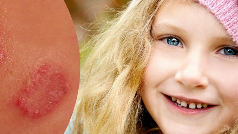 El término eczema también se conoce como dermatitis o inflamación de la piel, y define un conjunto de enfermedades de la piel que puede tener diferentes causas. (Pixabay)