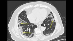 Médicos de EE.UU. que analizaron pulmones con COVID-19 dicen que se puede diagnosticar más rápido