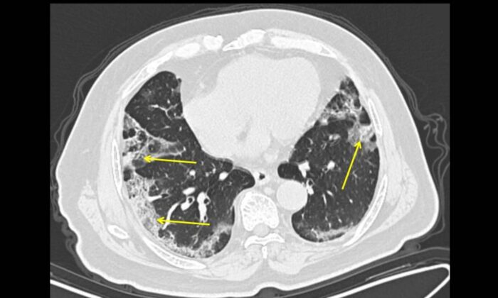 Un hombre de 65 años con un historial de viajes a Wuhan, presentando fiebre y tos. La tomografía computarizada obtenida a 11 días del inicio de los síntomas (grupo tardío) muestra una enfermedad pulmonar moderada con opacidades vitrales de base en los pulmones (flechas). (Hospital del Monte Sinaí)