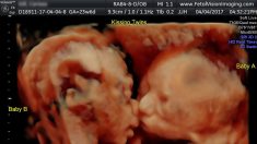 Ultrasonido de 24 semanas muestra un “beso” de dos gemelas en el útero y la foto se vuelven viral