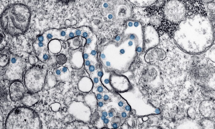 Esta imagen de microscopio electrónico 2020 puesta a disposición por los Centros para el Control y la Prevención de Enfermedades de EE. UU. Muestra las partículas esféricas del nuevo coronavirus, de color azul, del primer caso estadounidense de COVID-19. (AP-Hannah A. Bullock, Azaibi Tamin / CDC a través de AP / The Canadian Press)