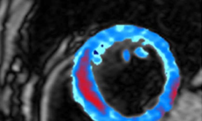 El área coloreada en esta resonancia magnética muestra una sección transversal de un músculo cardíaco, con un área de sangrado en rojo. AI y QIS tienen el potencial de revolucionar la atención médica y una variedad de otras tecnologías. (Cortesía del Imperial College London)