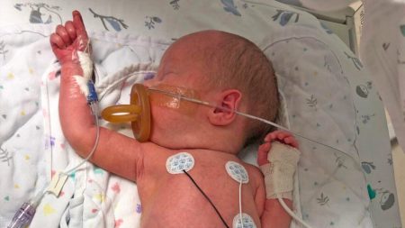 Bebé que nació con el intestino delgado fuera de su pequeño cuerpo se recupera de la grave cirugía