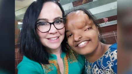 Adolescente con anormalidad facial casi se queda sin adoptar pero madre adoptiva logra llevarla a casa