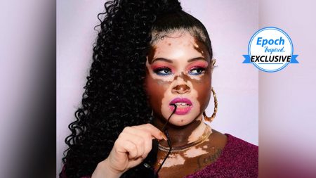 Mujer recibía burlas por tener vitiligo, pero se convirtió en modelo: «No importa lo qué piensen»