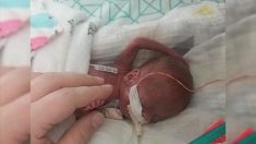 Bebé prematuro con 21 semanas de gestación se convierte en uno de los más pequeños en sobrevivir