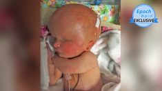 Bebé que nació sin dos tercios de su cerebro y sin ojos desafía expectativas de los médicos