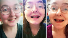 Mujer comparte fotografías de caries dental que sufrió durante 3 años por no cepillarse los dientes