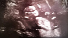 Imagen de ultrasonido muestra a un bebé con mascarilla y poco después la mamá contrae COVID-19