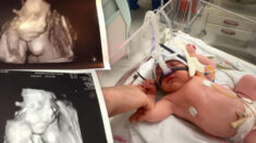 Bebé de 22 meses que sufrió colapso en los pulmones al nacer prospera con ayuda de los médicos