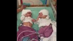 Gemelas unidas por la cabeza son separadas tras cirugía de 12 horas en Israel