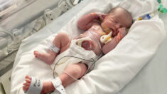 Bebé que nació con intestinos por fuera, ahora solo tiene un raro ombligo y crece saludable