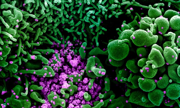 Micrografía electrónica de barrido coloreada de una célula (verde) fuertemente infectada con partículas del virus CCP (púrpura), comúnmente conocido como SARS-CoV-2 o nuevo virus del PCCh, aislado de una muestra de un paciente el 16 de marzo de 2020. (NIAID)