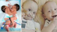 Papás se niegan abortar bebés siameses y hoy celebran sus 7 años tras exitosa cirugía de separación