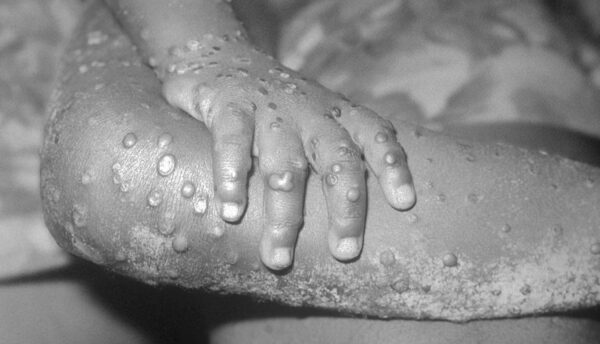 Una foto de 1971, del folleto de los Centros para el Control de Enfermedades, muestra lesiones similares a las de la viruela del mono en el brazo y la pierna de una niña en Bondua, Liberia. (CDC/Getty Images)
