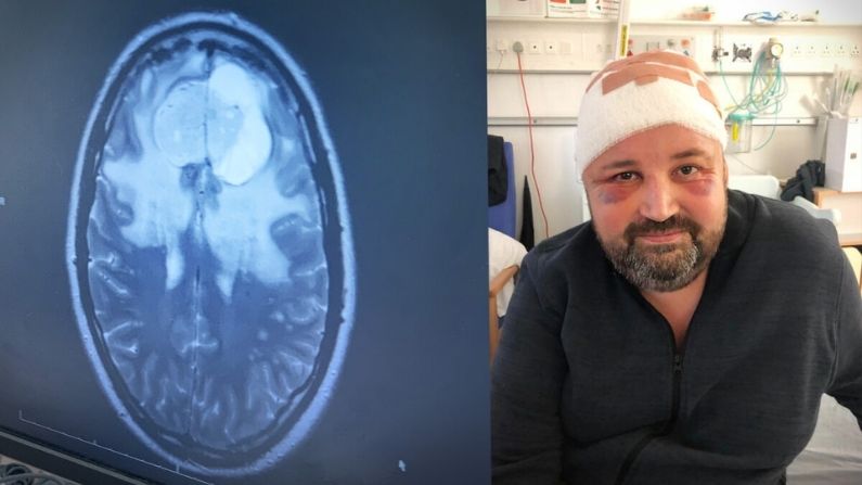 Hombre diagnosticado con 2 tumores cerebrales tiene increíble recuperación: "Un milagro andante"