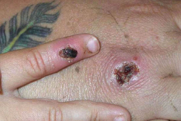 Los síntomas de un caso del virus de la viruela del mono se muestran en la mano de un paciente el 5 de junio de 2003. (CDC/Getty Images)