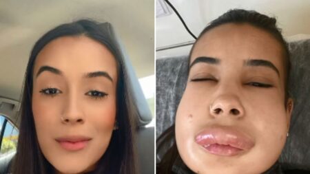 Joven termina con rostro deformado tras reacción alérgica para disminuir relleno de labios