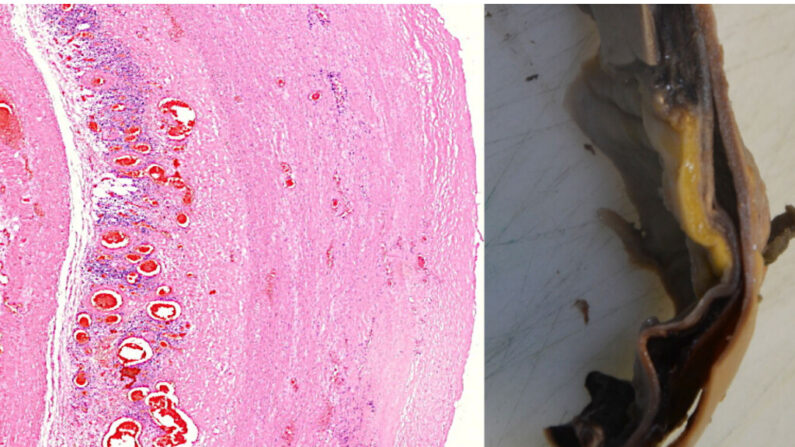 Una grieta en la pared de la aorta, revestida por grupos de linfocitos, que conduce a la ruptura de la aorta. (Michael Palmer, MD, Sucharit Bhakdi, MD)